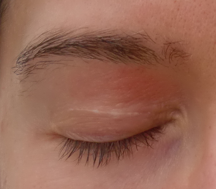Scaley skin on eyelids: Common Related Symptoms and ...